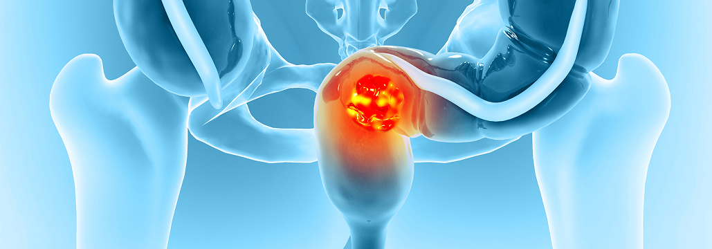 【直腸癌】手術のICG蛍光血管造影、 縫合不全を減らすか?