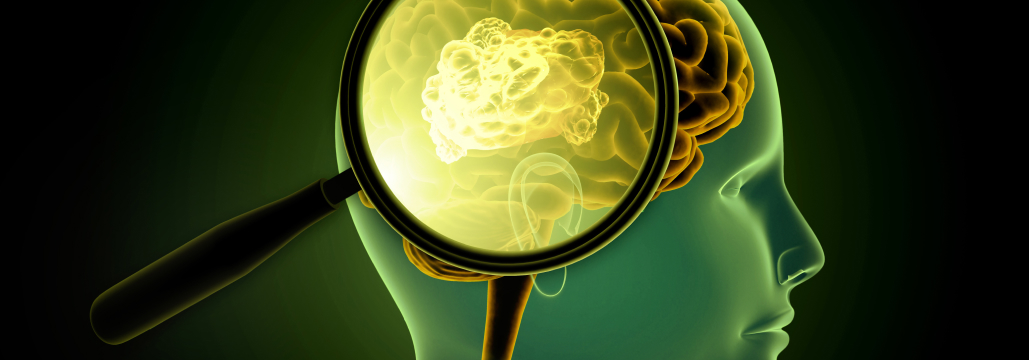 【Lancet Oncol】再発膠芽腫の再照射､ FET-PETは標準MRIを超えられるか？