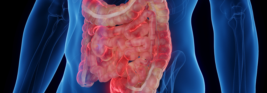 【Gastroenterology】中等症~重症のクローン病にグセルクマブが有効