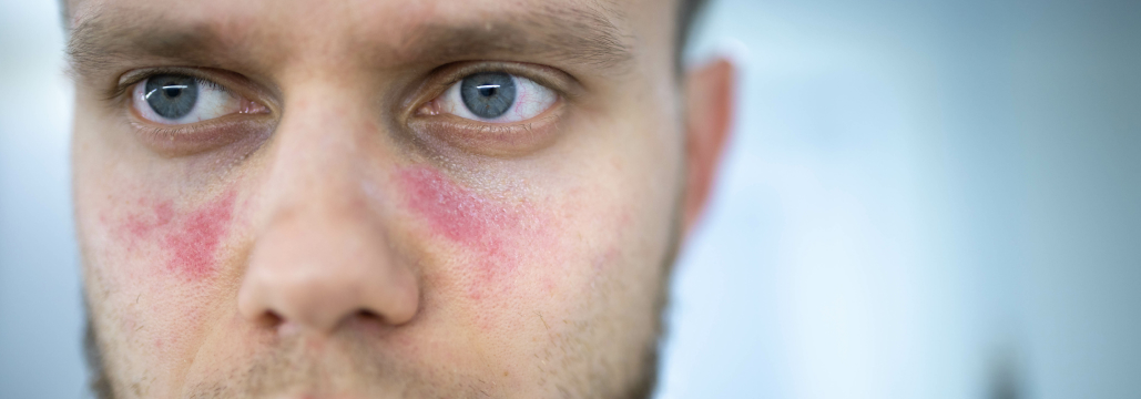 【NEJM】SLEの疾患活動性を有意に改善､ 新規組み換え融合二重阻害薬 telitacicept