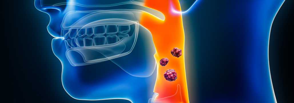 【Lancet】中咽頭癌へのIMPT､ IMRTと晩期QOL･OS同等