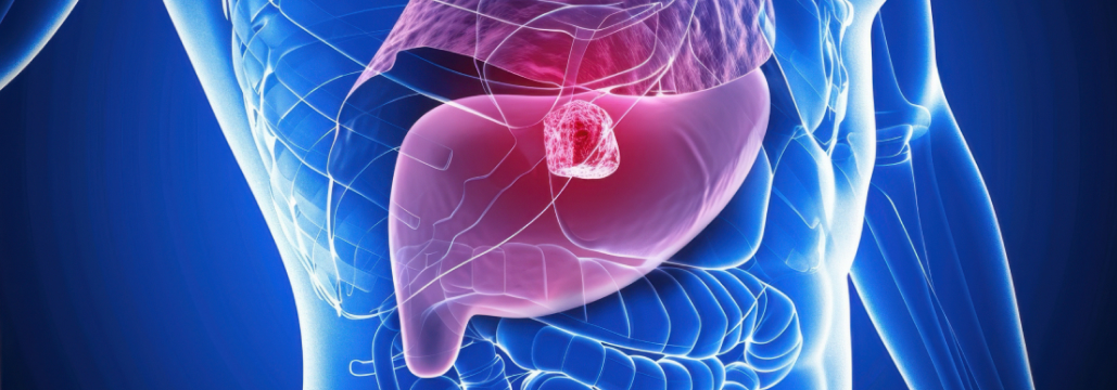 【Lancet Oncol】切除不能HCCの1次治療､ anlotinib＋penpulimabで死亡リスク減