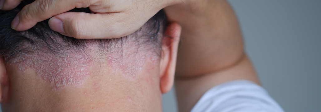 【JAMA Dermatol】乾癬の頭皮･体幹病変にPDE4阻害薬roflumilastフォームが有効