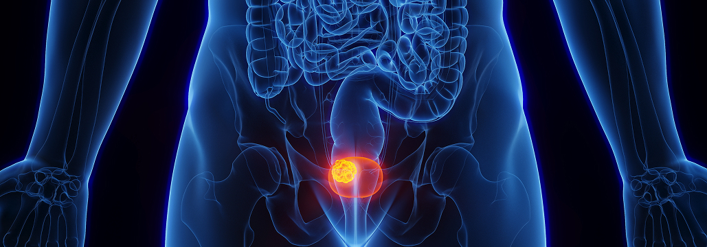 【CTO】SEOM–SOGUG膀胱癌ガイドライン 2025年版が発表､ 主な変更点は？