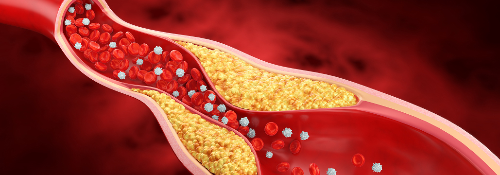 【EHJ】脂質異常症管理のESC/EASガイドラインが2025年版に改訂