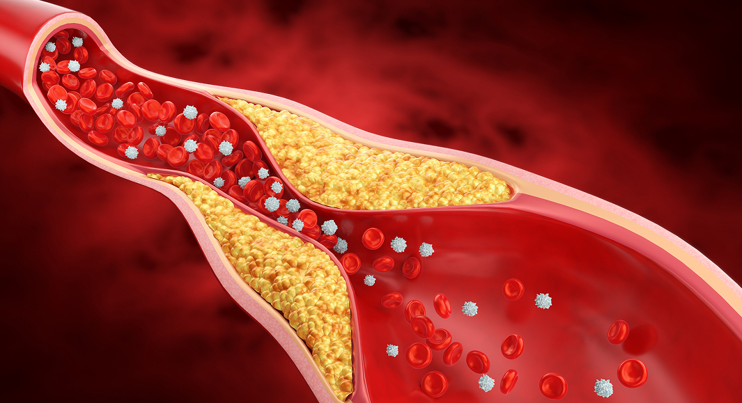 【EHJ】脂質異常症管理のESC/EASガイドラインが2025年版に改訂