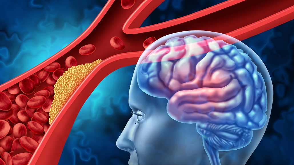 【Stroke】急性期脳梗塞への新規血栓溶解薬スタフィロキナーゼが有望