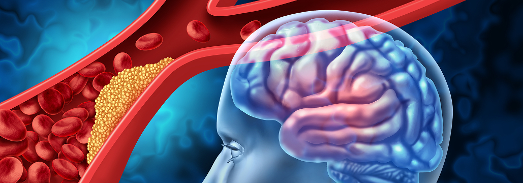 【Stroke】急性期脳梗塞への新規血栓溶解薬スタフィロキナーゼが有望