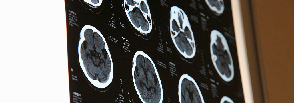 【Neurosurgery】脳･脊髄 海綿状血管奇形の管理ガイドライン : 53の推奨