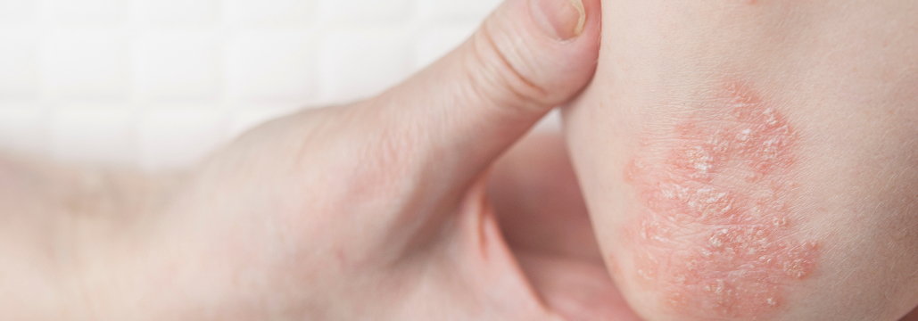 【乾癬】チルドラキズマブ､ ｢遅発性｣でより高い効果