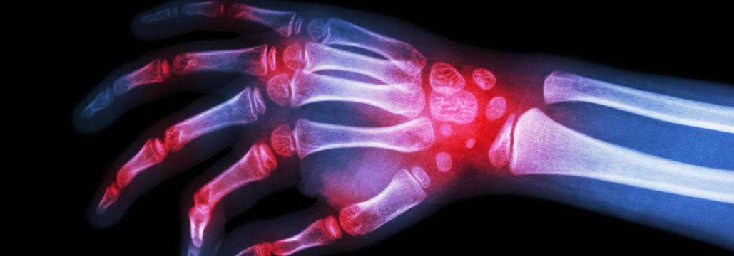 【Arthritis Care Res】関節リウマチ併存、ICI治療後NSCLCの予後に影響は？
