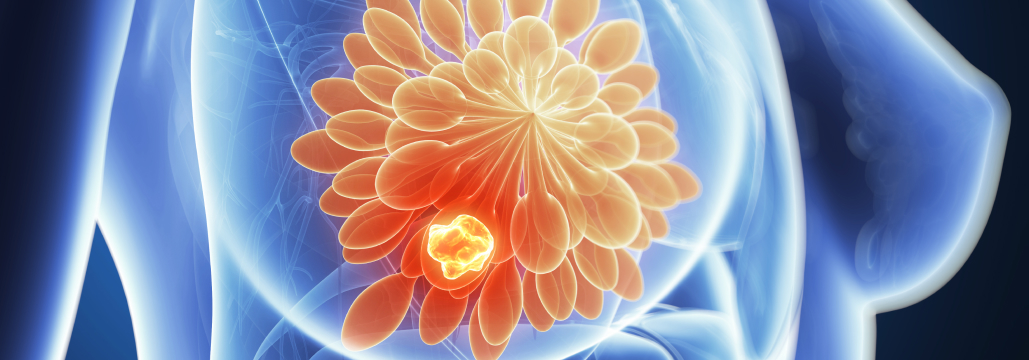 【Nat Commun】gBRCA陽性乳癌の術前療法、 オラパリブ併用でOS改善