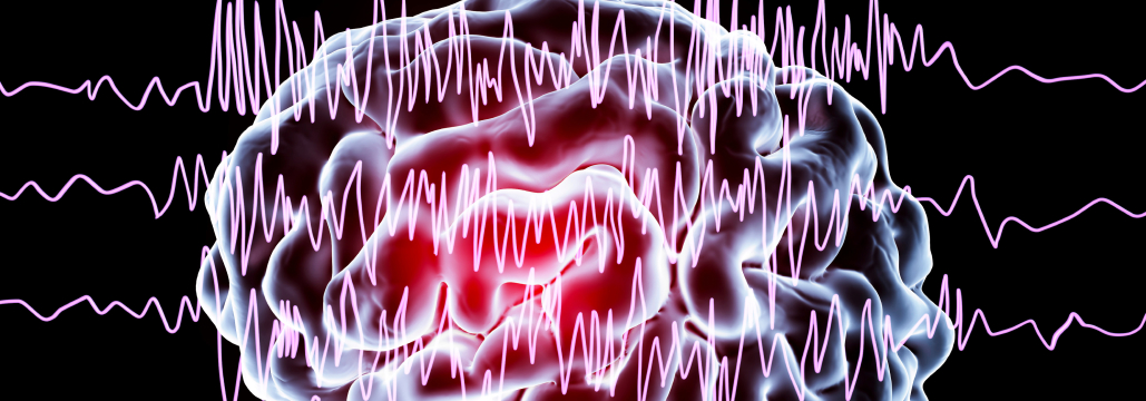 【Neurology】焦点てんかん､非最適な睡眠で認知症リスクが5倍に増加
