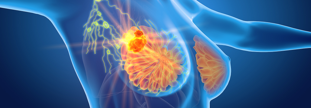 【JCO】高リスクER+/HER2-早期乳癌､ 予後良好例を特定する新アッセイ