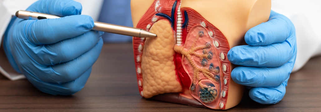 【Respirology】NSCLC術後の肺機能、 回復に“肺葉差”あり