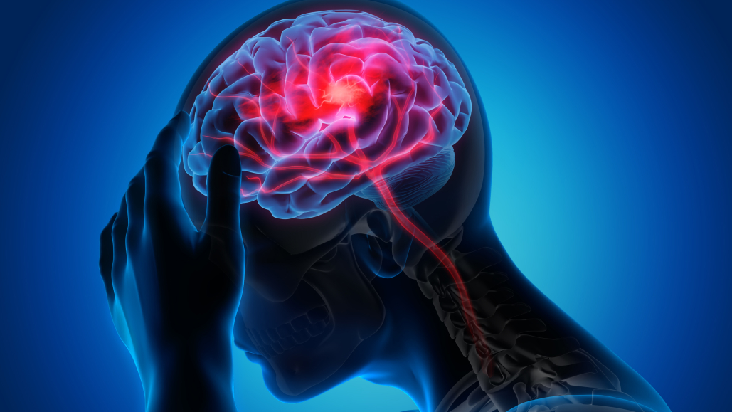 【JAMA Neurol】心房細動患者の左心耳閉鎖術､ 脳卒中後転帰と死亡率を改善