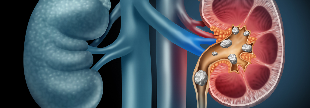 【Lancet】尿路結石再発､ 水分摂取介入でも通常診療と差なし