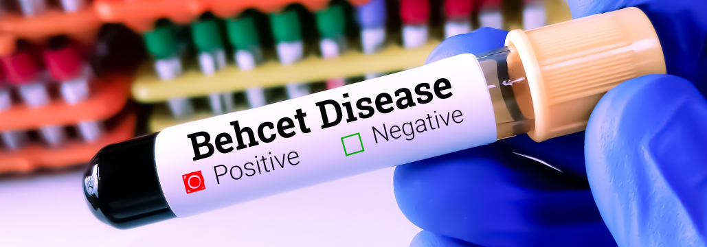 【Ann Rheum Dis】ベーチェット病､ 新PDE4阻害薬で口腔潰瘍を改善