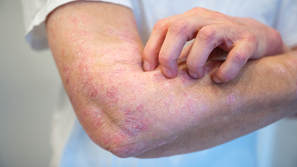 【NEJM】中等症~重症乾癬に経口IL-23受容体阻害薬が奏効 : 第Ⅲ相ICONIC-LEAD