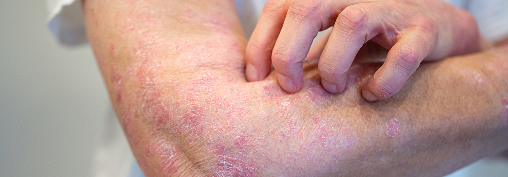 【JAMA Dermatol】乾癬+肥満にチルゼパチド追加、 皮膚症状と体重を両立改善