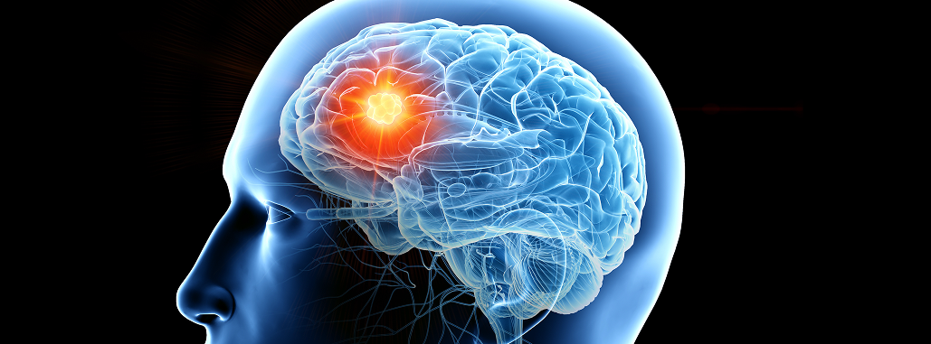 【Lancet Oncol】メラノーマ脳転移へのイピリムマブ＋ニボルマブ､ 7年以上効果を維持