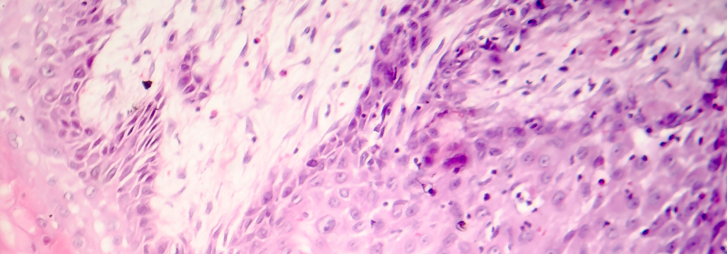 【Nat Med】有棘細胞癌の術前療法、ニボルマブ＋イピリムマブで病理学的奏効率 80％