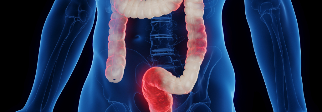 【Clin Gastroenterol Hepatol】中等症~重症潰瘍性大腸炎に最も有効な薬剤は？