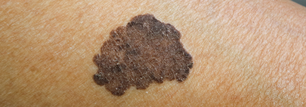 【Br J Dermatol】BRAF融合型巨大先天性母斑 : 痒み硬結と線維性変化