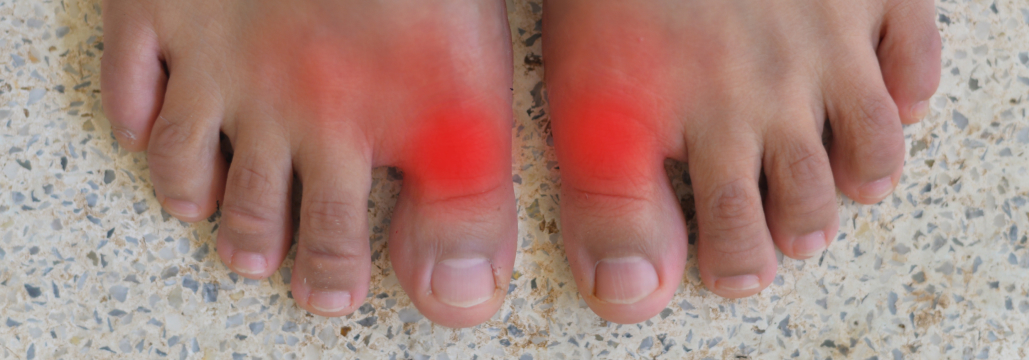 【Arthritis Rheumatol】日本人女性の尿酸値､ 閉経期に急上昇