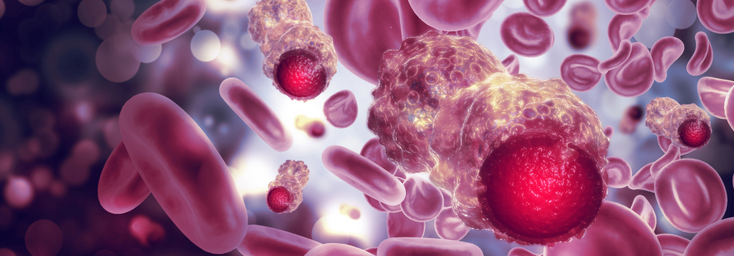 【NEJM】固形癌の死亡リスクに腫瘍浸潤クローン性造血が関与か