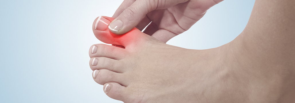 【痛風】尿酸排泄率 (FEUA) がアロプリノールの尿酸低下効果を左右