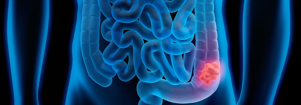 【Surg Endosc】多発大腸癌肝転移に対する腹腔鏡下複合治療の有効性