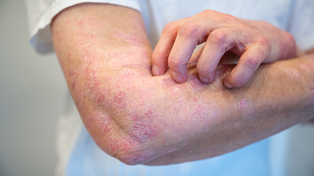 【JAMA Dermatol】乾癬の症状改善に｢地中海食｣が寄与