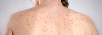 【NEJM】早期梅毒治療､ ペニシリンG単回投与は3回投与に非劣性