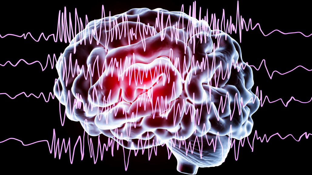【Neurology】ラモトリギンによる不整脈リスク増加は示されず: 後ろ向きコホート研究