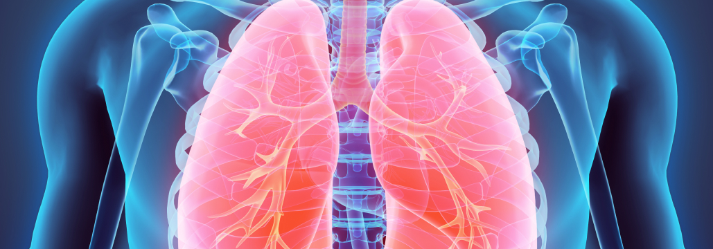 【Lancet】EGFR-TKI後のMET増幅NSCLCにMET阻害薬+オシメルチニブでPFS改善