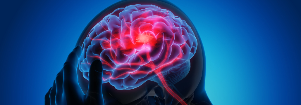 【Neurology】後方循環系脳梗塞の血栓回収、 t-PA先行投与は機能予後と死亡率を改善