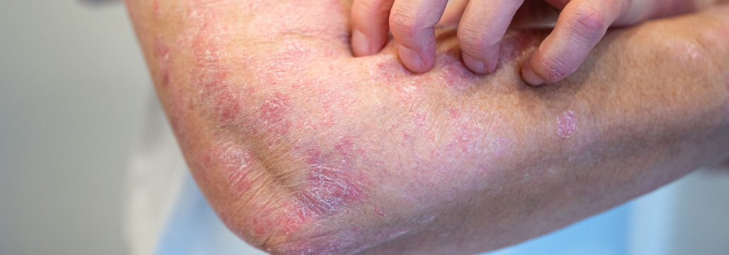 ​​【Lancet】経口IL-23Rペプチド阻害薬icotrokinra､ 中等症~重症乾癬に有効