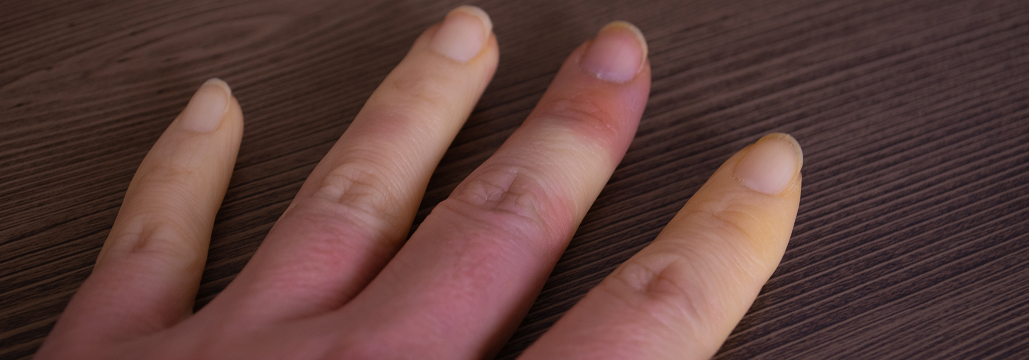 ボツリヌス毒素治療でCR率9割超：全身性強皮症に伴う難治性指虚血･指潰瘍