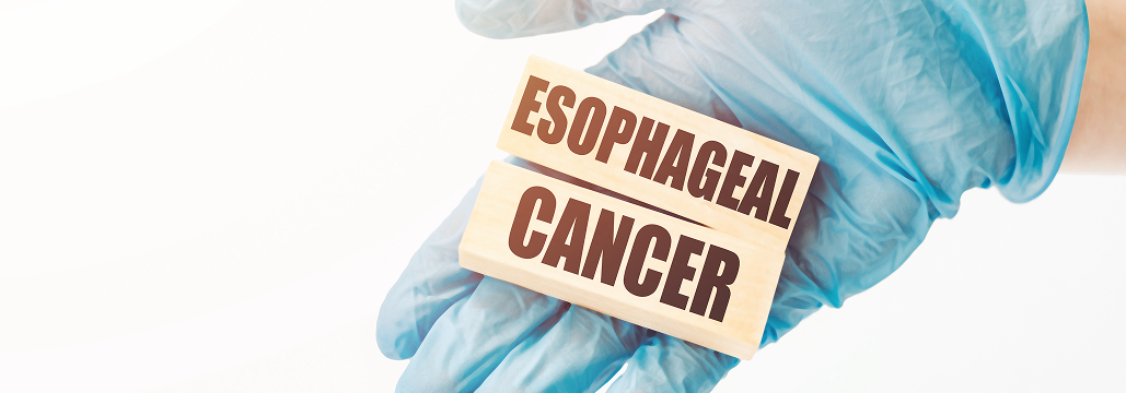 【Eur J Surg Oncol】ESCCの予後予測に術前ctDNA測定が有用