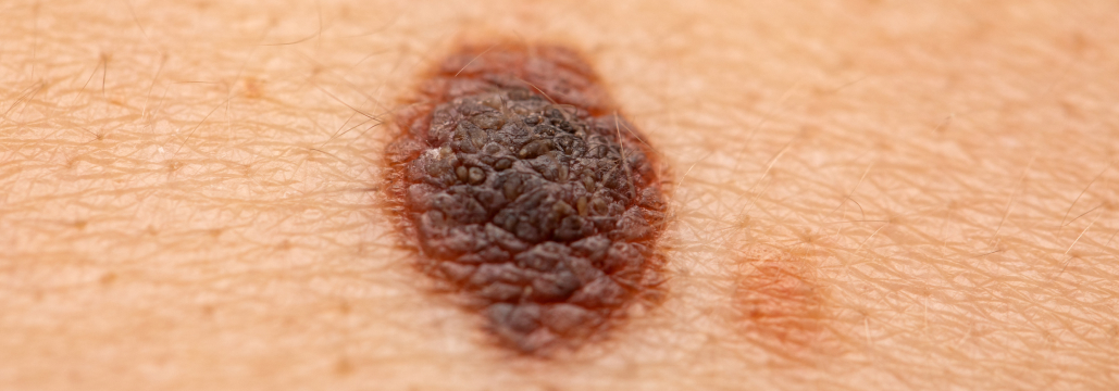 【Nat Cancer】線維形成性黒色腫､術前ペムブロリズマブでpCR率71%