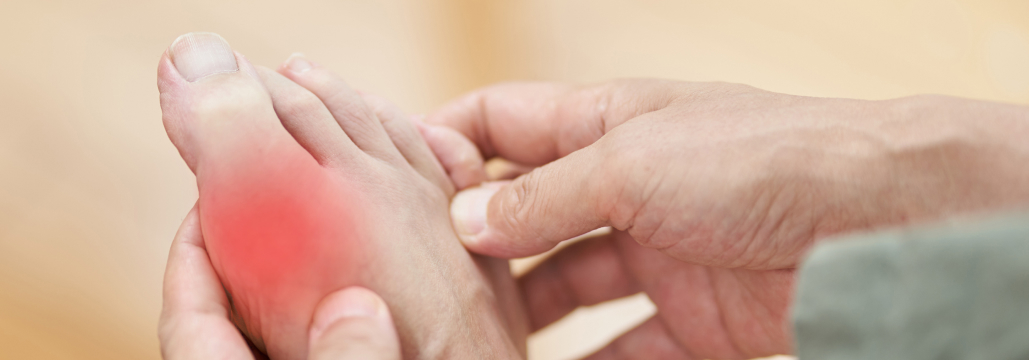 【Arthritis Rheumatol】痛風治療､ ドチヌラド vs フェブキソスタット