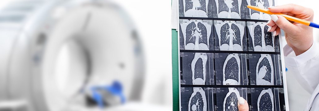 【Lung Cancer】肺癌＋間質性肺疾患に対するRT治療の実践的推奨 : Delphiコンセンサス