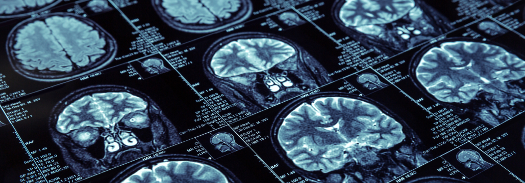 【NEJM】特発性正常圧水頭症、 シャント術は歩行速度を改善も認知・排尿機能は改善せず
