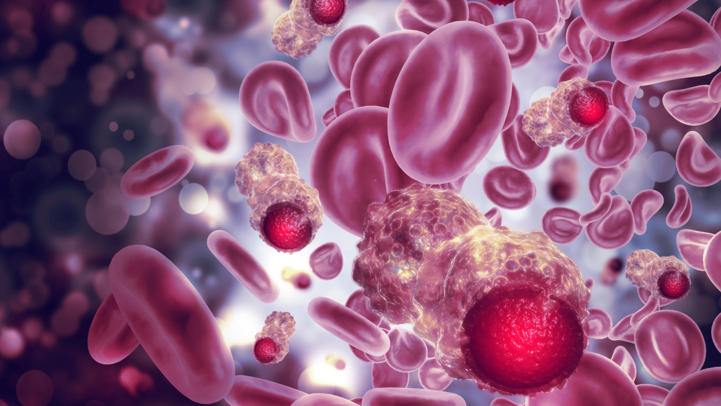 【Lancet】難治性大腸癌にzanzalintinib＋アテゾリズマブでOS改善