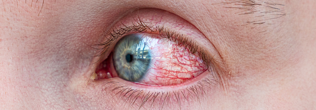 【J Ophthalmic Inflamm Infect】乾癬患者は結膜充血やドライアイのリスクが高い