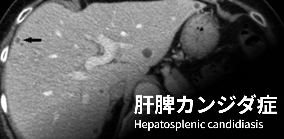 肝脾カンジダ症 (慢性播種性カンジダ症) Hepatosplenic candidiasis