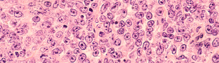 【Haematologica】再発/難治性DLBCLへのtafasitamab＋レナリドミドが長期でも有効