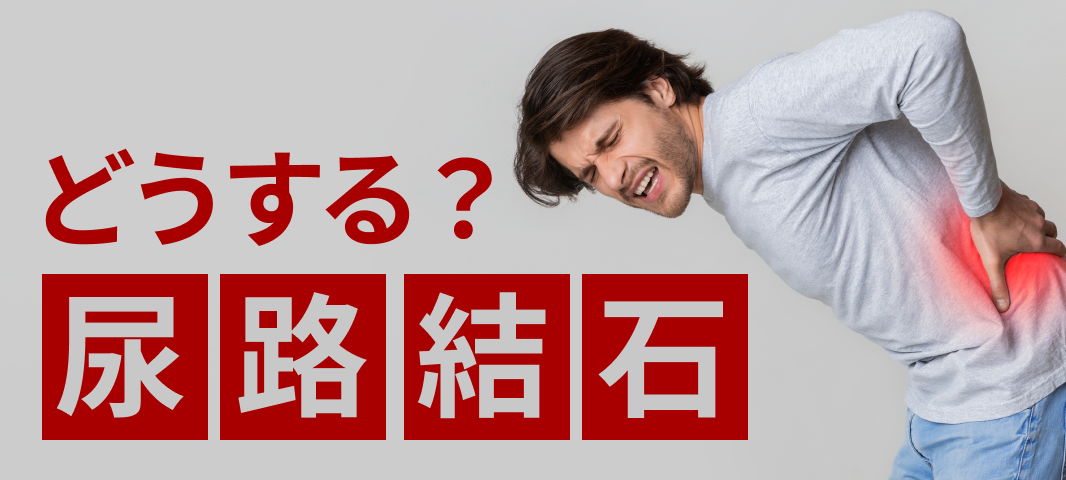 【尿路結石症】診断と治療、 どんな患者で専門的治療が必要?