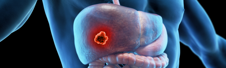 【Lancet】再発高リスクの肝細胞癌術後療法､アテゾリズマブ+ベバシズマブでRFS改善